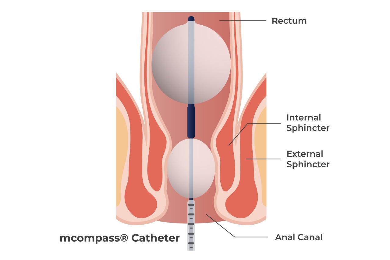 Anorectal Manometry Diagram